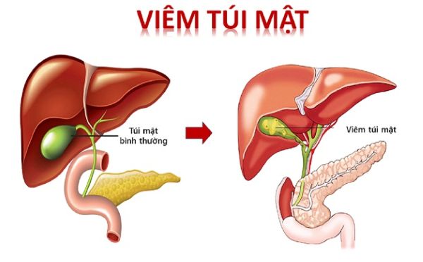 Viêm túi mật là một bệnh lý đường tiêu hóa thường gặp