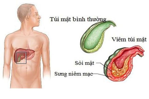 Viêm túi mật là tình trạng viêm nhiễm xảy ra ở túi mật, thường do vi khuẩn