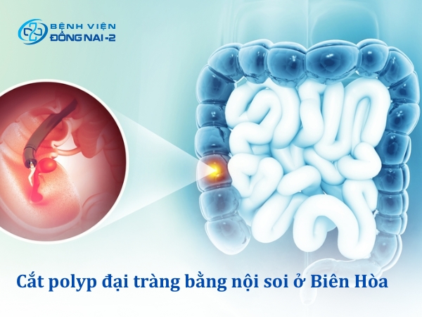 Thủ thuật cắt polyp đại tràng bằng nội soi