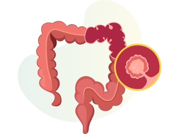 Polyp đại tràng là sự tăng sinh bất thường của các tế bào trên lớp niêm mạc đại tràng