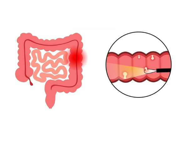 Cắt polyp đại tràng bằng phương pháp nội soi