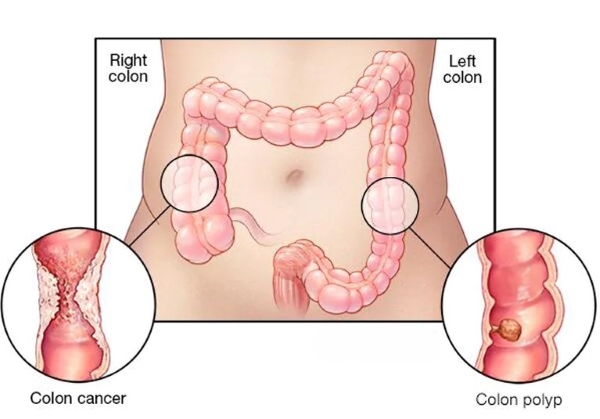 Ung thư đại tràng có thể xuất hiện ở bất kỳ vị trí nào trong đại tràng