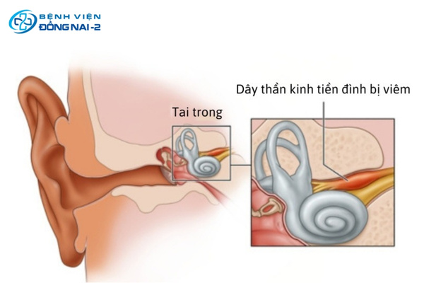 Viêm dây thần kinh tiền đình gây đau đầu buồn nôn, chóng mặt dữ dội