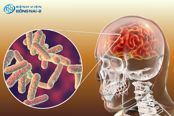 Xuất huyết não, u não, viêm màng não là các bệnh lý nguy hiểm cần can thiệp sớm