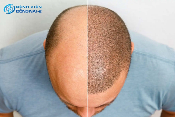 Phẫu thuật cấy tóc là phương pháp điều trị nguyên nhân rụng tóc nặng