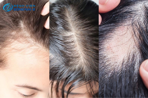 Tóc thưa mỏng, hói cục bộ, đường chân tóc lùi dần là những dấu hiệu nhận biết rụng tóc bất thường