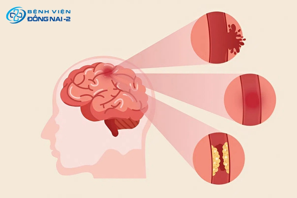 Đau đầu dữ dội đột ngột kèm méo miệng, yếu liệt một bên người là dấu hiệu tai biến mạch máu não