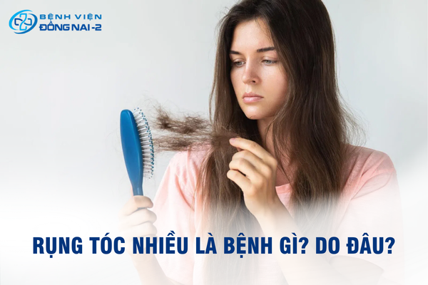 Tóc rụng nhiều là dấu hiệu cảnh báo bệnh lý tiềm ẩn cần được chẩn đoán sớm