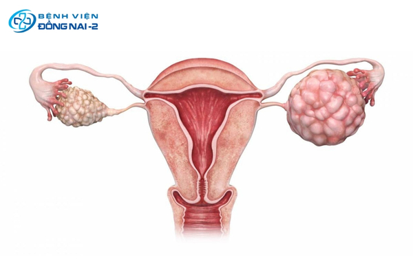 Hội chứng buồng trứng đa nang gây rụng tóc nhiều ở phụ nữ 