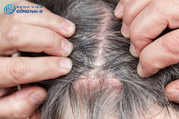 Bệnh da đầu gây viêm da tiết bã, nấm da đầu, vảy nến tổn thương nang tóc