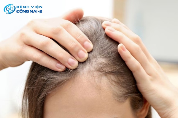 Điều trị tóc rụng nhiều bằng PRP huyết tương, cấy tóc, laser LLLT và điều trị bệnh lý nền