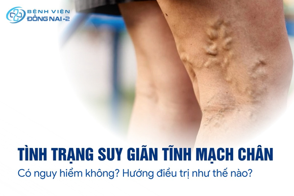 Giãn tĩnh mạch chân ảnh hưởng đến thẩm mỹ và tiềm ẩn nhiều biến chứng nguy hiểm