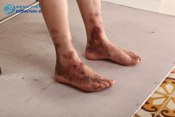 Hình ảnh biến chứng nguy hiểm của bệnh giãn tĩnh mạch chân nếu không được điều trị