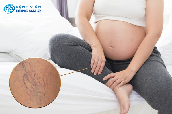 Phụ nữ mang thai thay đổi nội tiết tố có nguy cơ mắc bệnh suy giãn tĩnh mạch chân