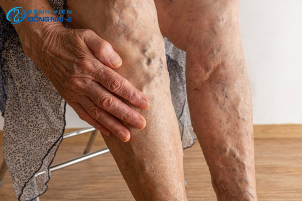 Giai đoạn đầu bệnh giãn tĩnh mạch chân với triệu chứng sưng nhẹ và đau nhức âm ỉ