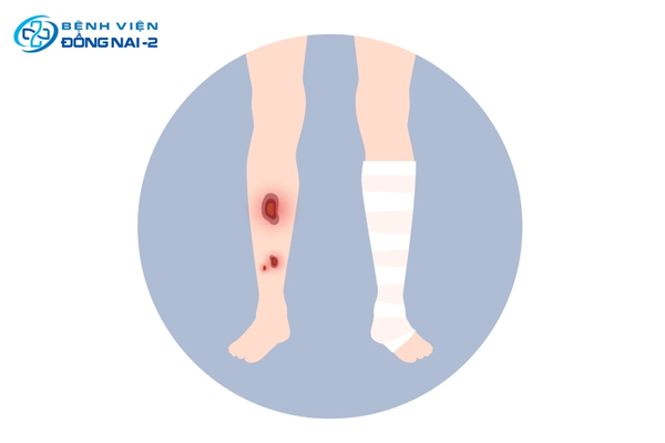 Vết loét mạn tính ở chân do bệnh giãn tĩnh mạch chân giai đoạn cuối