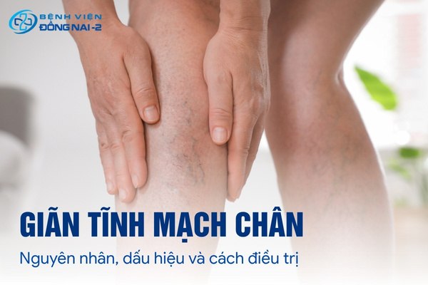 Giãn tĩnh mạch chân cần được phát hiện và điều trị sớm