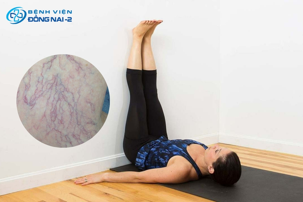 Vận động đúng cách, kê cao chân giúp giảm triệu chứng giãn tĩnh mạch chân hiệu quả