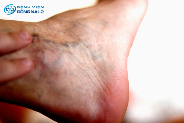 Phù nề vùng cổ chân và bàn chân là triệu chứng khi áp lực tĩnh mạch tăng cao