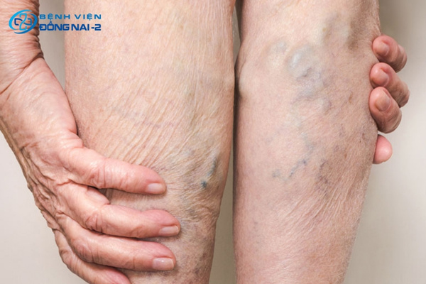 Viêm tĩnh mạch nông là biến chứng nguy hiểm do giãn tĩnh mạch chân