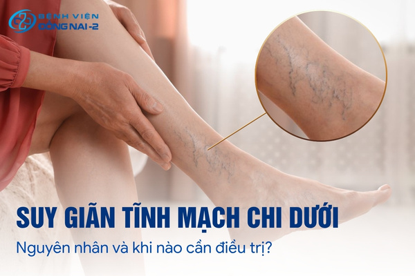Suy giãn tĩnh mạch chi dưới có xu hướng gia tăng ở cả người trẻ tuổi trong những năm gần đây
