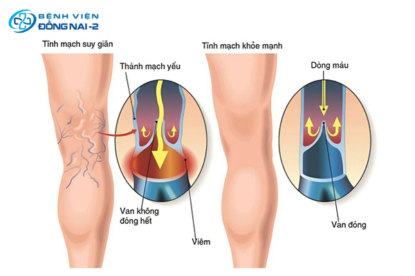 Suy giãn tĩnh mạch xảy ra khi máu bị ứ đọng tại hai chân, gây tăng áp lực trong lòng mạch