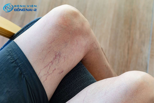 Suy giãn tĩnh mạch chi dưới tiến triển từ cảm giác nặng chân đến loét da mãn tính