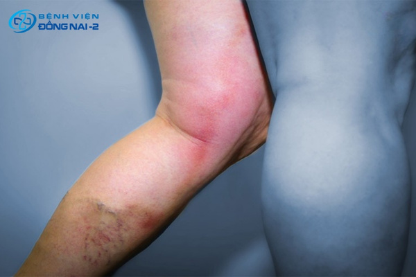 Cần thăm khám khi phù nề dai dẳng, tĩnh mạch nổi rõ hoặc thay đổi da vùng cẳng chân