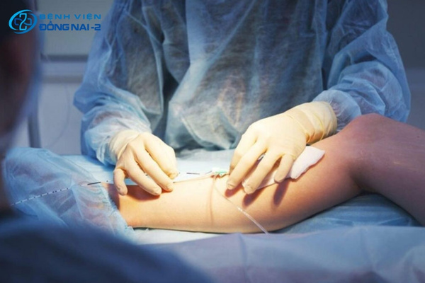 Có 03 phương pháp điều trị can thiệp tình trạng suy giãn tĩnh mạch chi dưới