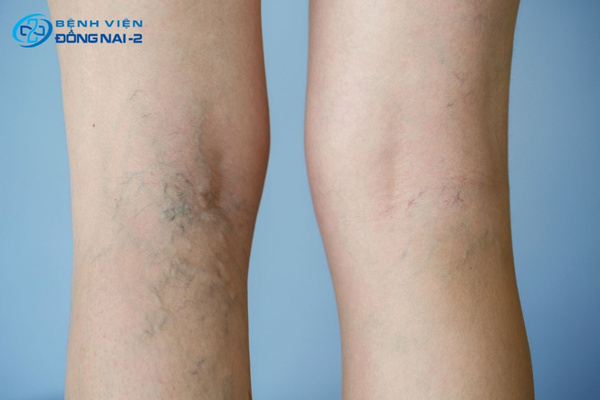 Phòng ngừa suy giãn tĩnh mạch bằng cách duy trì vận động, tránh ngồi lâu