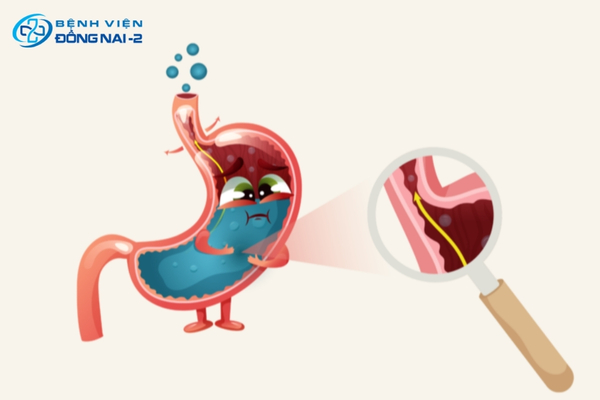 Cơ vòng thực quản dưới hoạt động kém hiệu quả khiến axit trào ngược