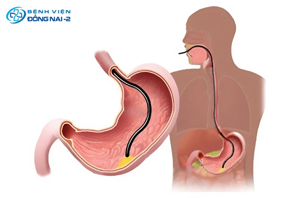Nội soi thực quản dạ dày giúp bác sĩ chẩn đoán mức độ trào ngược dạ dày và đưa ra hướng điều trị