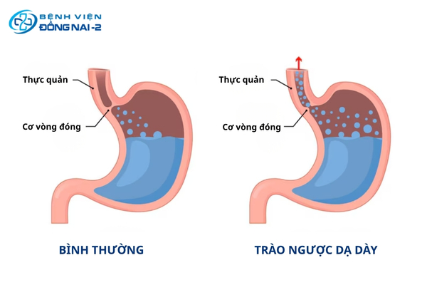 Hình minh họa cơ chế trào ngược dạ dày thực quản 