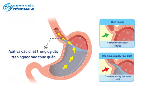Hình minh họa cơ chế trào ngược dạ dày thực quản và cơ thắt thực quản dưới