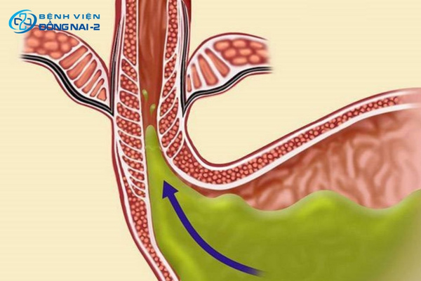 GERD xuất phát từ suy yếu cơ thắt thực quản dưới, thoát vị hoành, béo phì và thói quen thiếu khoa học