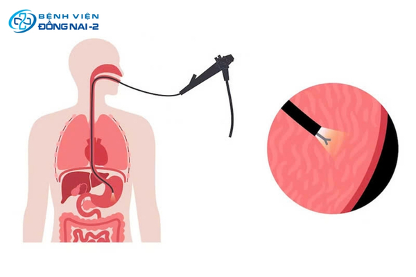 Nội soi dạ dày giúp chẩn đoán GERD và phát hiện biến chứng