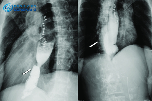 Chụp X-quang đường tiêu hóa trên với dung dịch bari giúp hiển thị rõ hình ảnh thực quản và dạ dày