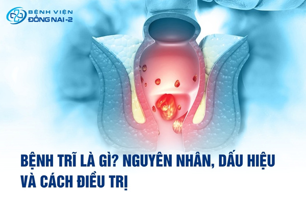Bệnh trĩ không nguy hiểm đến tính mạng nhưng ảnh hưởng đến chất lượng cuộc sống