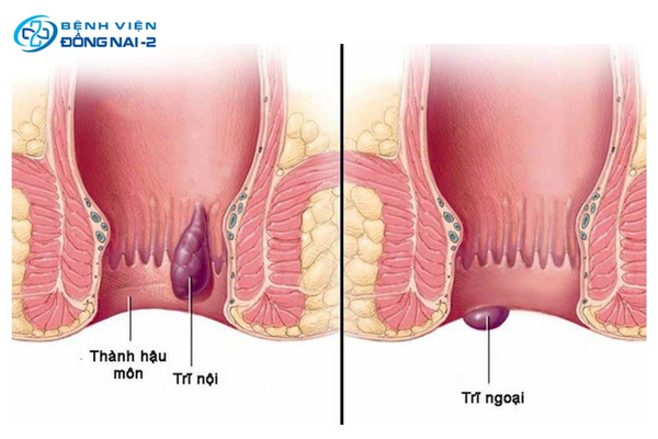 Phân biệt trĩ nội và trĩ ngoại dựa trên vị trí hình thành so với đường lược hậu môn