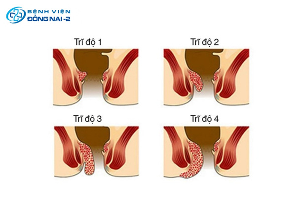 Sơ đồ phân độ bệnh trĩ từ độ 1 đến độ 4 theo mức độ sa búi trĩ