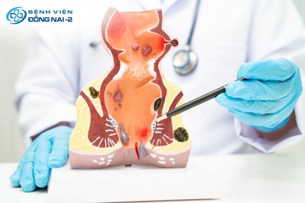 Điều trị bệnh trĩ bằng biện pháp thắt dây chun, xơ hóa, quang đông hồng ngoại hoặc phẫu thuật