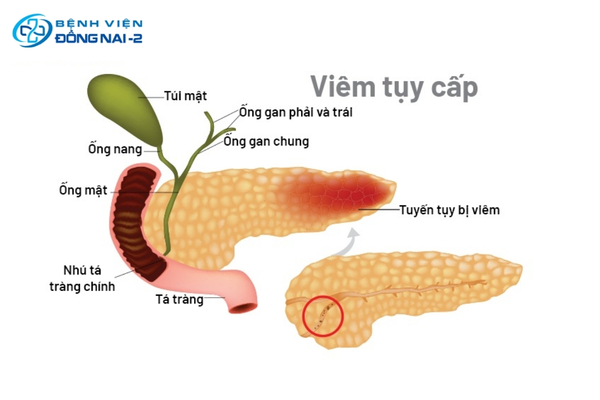 Viêm tụy cấp gây hạ canxi máu do phản ứng chelate với lipid
