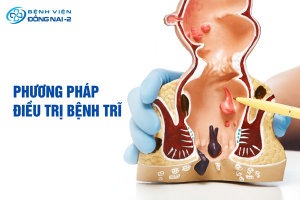 Các phương pháp điều trị bệnh trĩ mới nhất, giúp giảm đau đớn, rút ngắn thời gian hồi phục