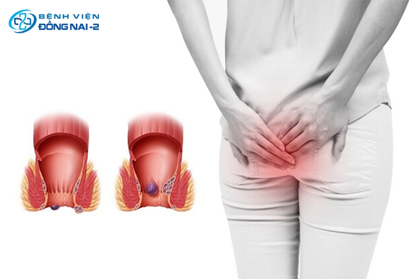 Mỗi loại trĩ có mức độ triệu chứng và chỉ định điều trị khác nhau
