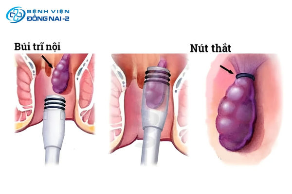Thắt vòng cao su là phương pháp không cần gây mê, phù hợp cho trĩ nội độ 1 và độ 2