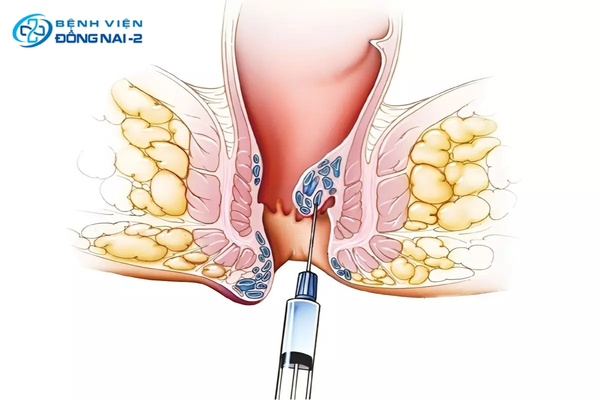 Phương pháp tiêm xơ búi trĩ không đau, bệnh nhân có thể về nhà ngay sau thủ thuật