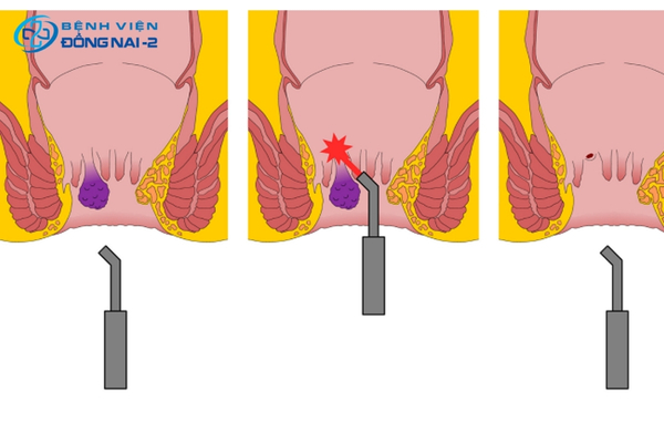 Laser điều trị trĩ cho phép cắt bỏ búi trĩ chính xác, ít đau, ít chảy máu và thẩm mỹ cao