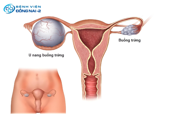 U nang buồng trứng phát triển gây chèn ép bàng quang, dẫn đến tiểu buốt, tiểu rắt