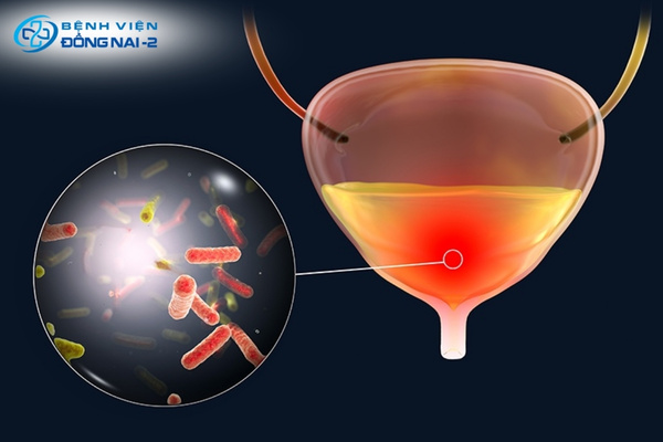 Viêm đường tiết niệu do vi khuẩn E. coli gây ra tình trạng tiểu buốt, tiểu rắt và tiểu ra máu