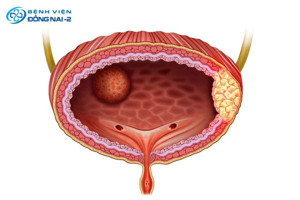 Tiểu ra máu không đau có thể là dấu hiệu sớm của ung thư bàng quang